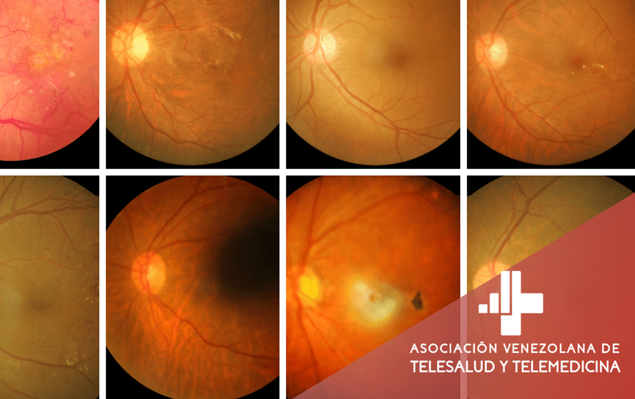 Retinopatía diabetica Vs. Inteligencia Artificial